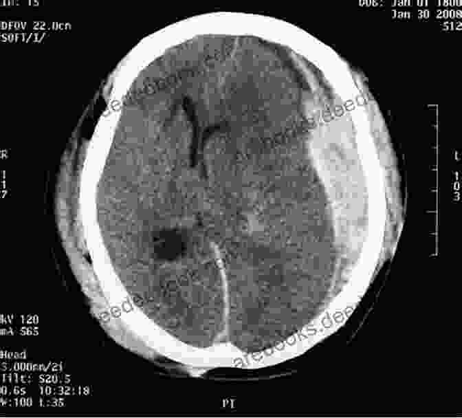 A CT Scan Showing A Large Subdural Hematoma Subdural Hematoma: Past To Present To Future Management