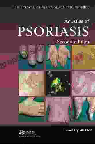 Atlas Of Psoriasis (Encyclopedia Of Visual Medicine 77)
