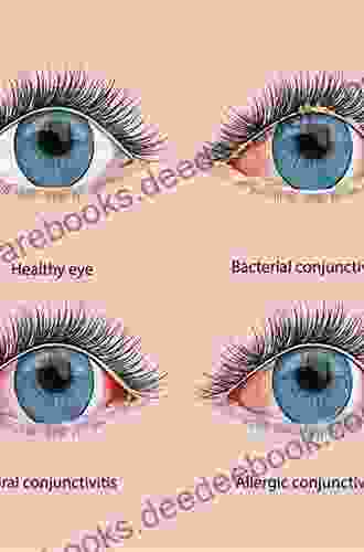 Infections Of The Cornea And Conjunctiva